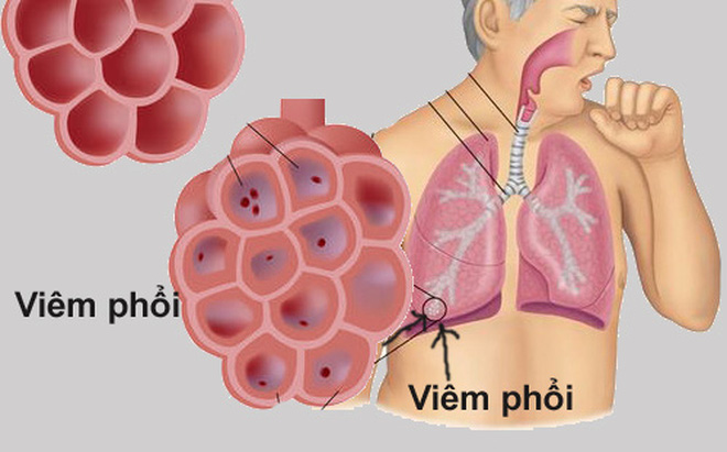 Bệnh viêm phổi không sốt có nguy hiểm không?