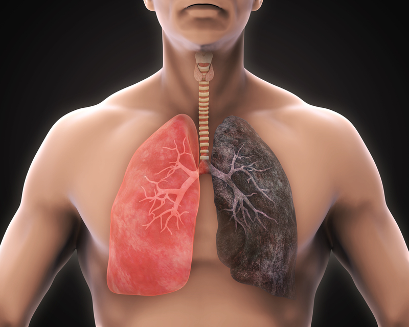 Chăm sóc bệnh nhân viêm phổi không sốt